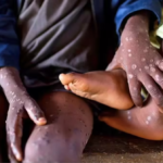 Mpox and the measure of Africa’s health resolve