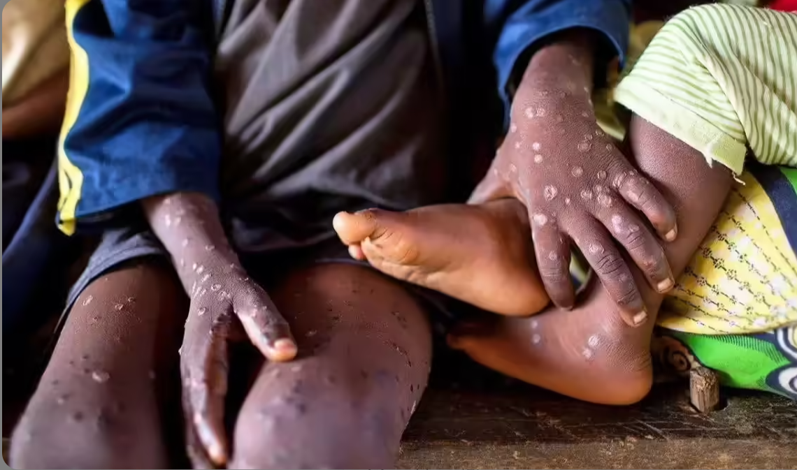 Mpox and the measure of Africa’s health resolve