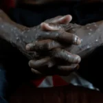 Beyond the Outbreak: Lessons from the DRC’s Two-Year Mpox Crisis