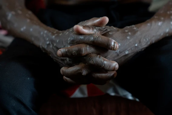 Beyond the Outbreak: Lessons from the DRC’s Two-Year Mpox Crisis